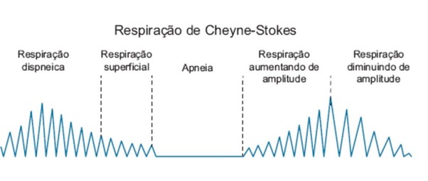 O ritmo de cheyne-stokes caracteriza-se por um aumento progressivo da amplitude das incursões respiratórias até atingir um ponto máximo. Em seguida, as incursões respiratórias começam a decrescer até chegar a um novo período de apneia.